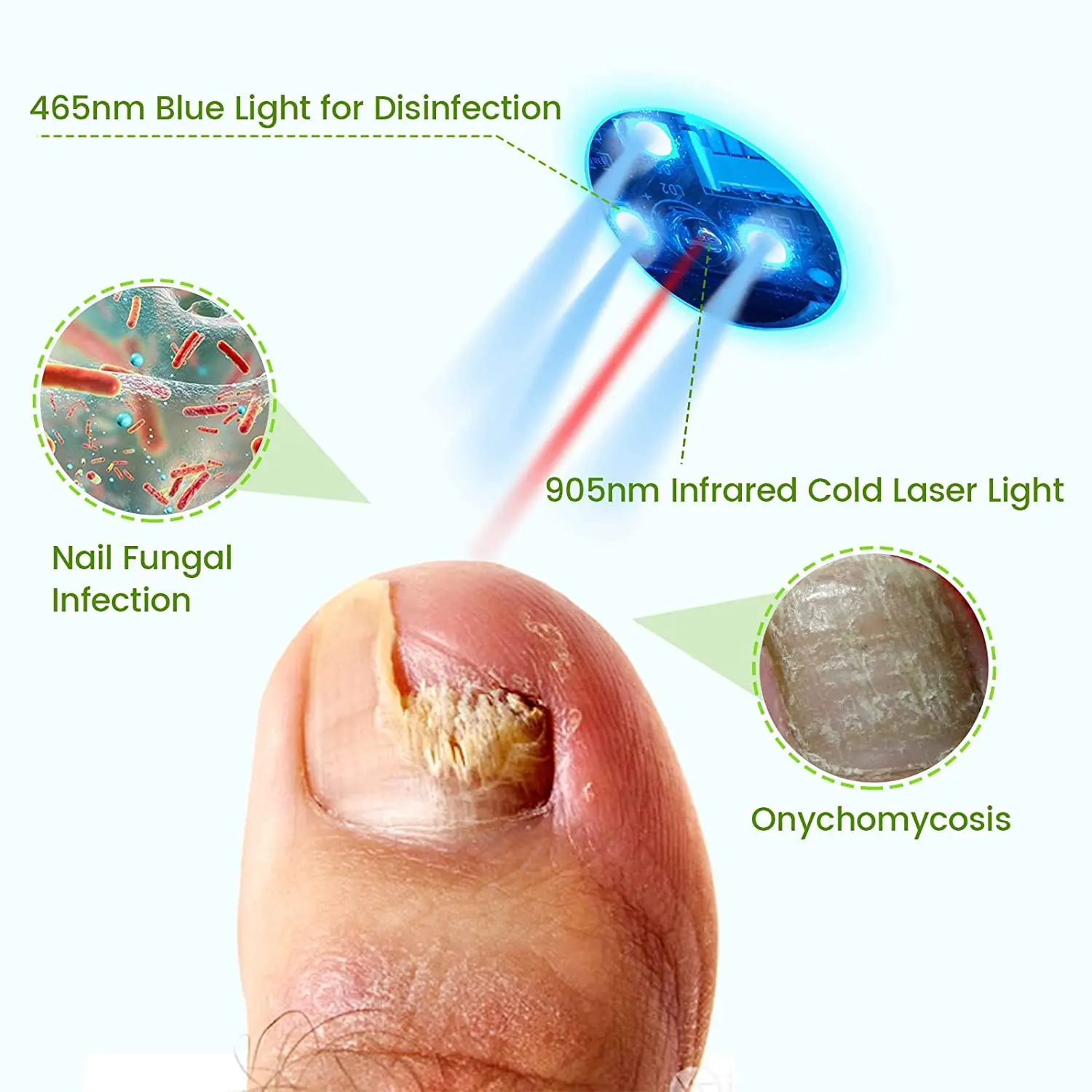 High Quality Onychomycosis Cure Machine Foot Care Tool Hand Foot Toe Finger Fungal Fungi Nail Fungus Cleaning