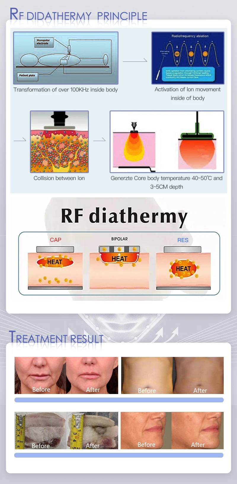 2 handles 448khz monopolar radio frequency deep penetration CET RET muscle souring repair anti-aging machine