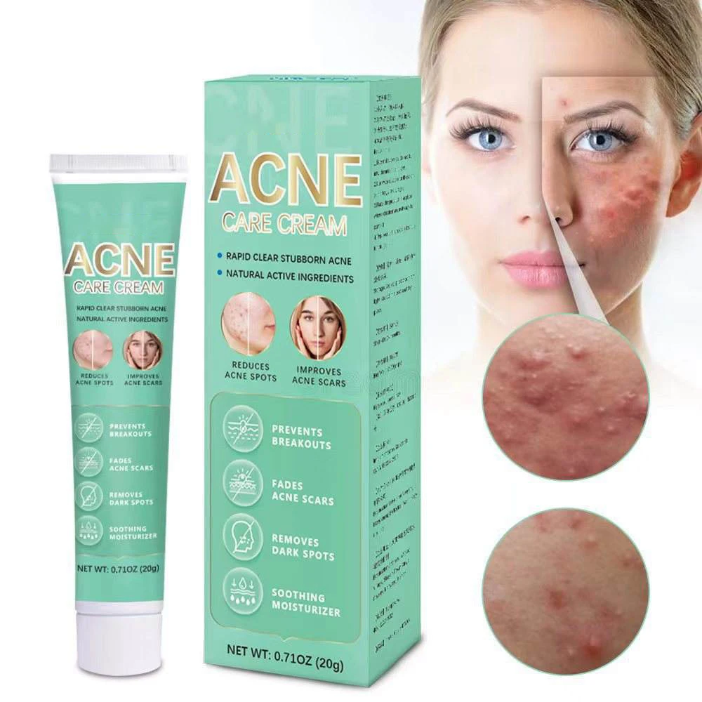 Wholesale  face for oily sensitive prone skin face anti cleansing skin natural acne scar removal treatment acne acne gel