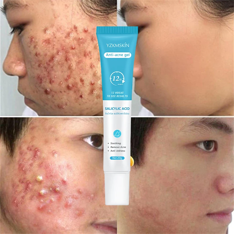 OEM customized Fast Effective Face Care Natural Treatment Keloid Repair Cream skin care Repair Scars Salicylic Acne Cream