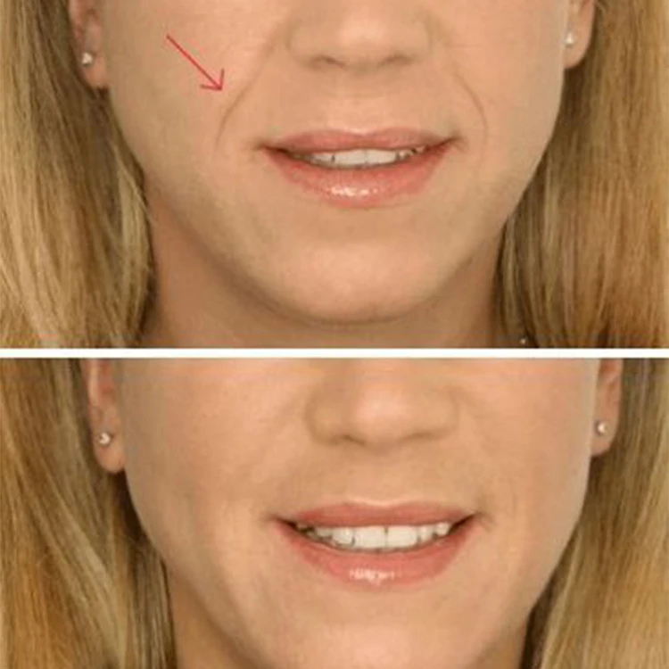 surgical suture fine effective face and body lifting aptos ultra v line hilo tensor lift mesh pcl thread