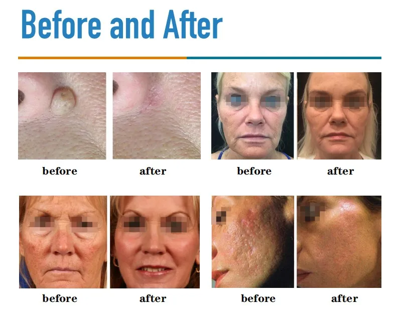 ADSS co2 resurfacing laser CO2 Fractional Laser machine for laser scars removal skin resurfacing vaginal tightening