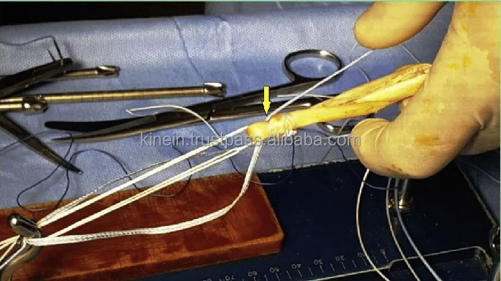 Ортопедический имплантат с регулируемой петлей