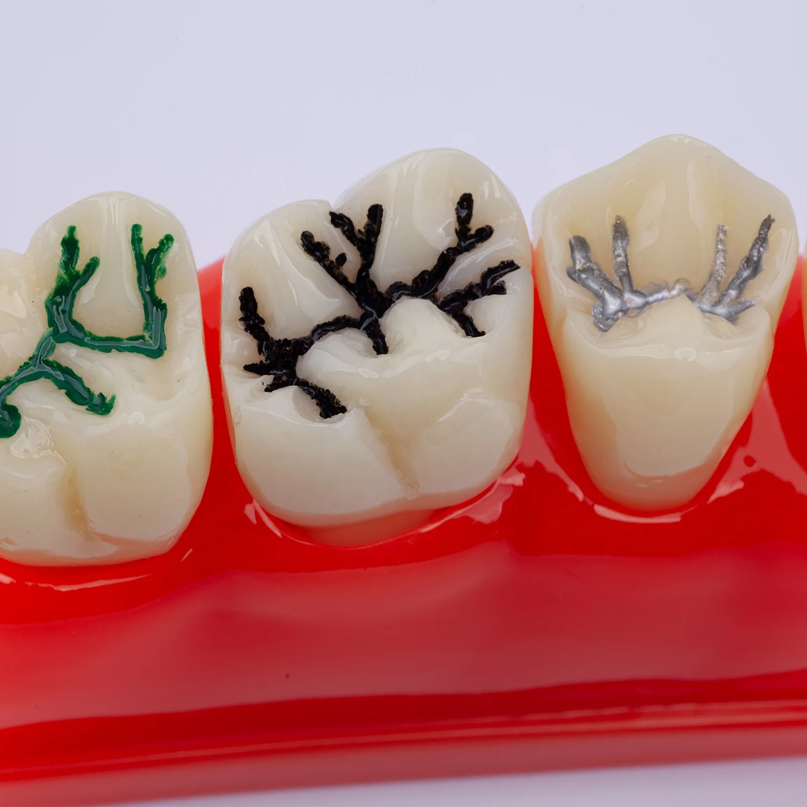 Pit and Fissure Sealant Teeth Model Demonstration Dental Model for for Patients Communication and Education