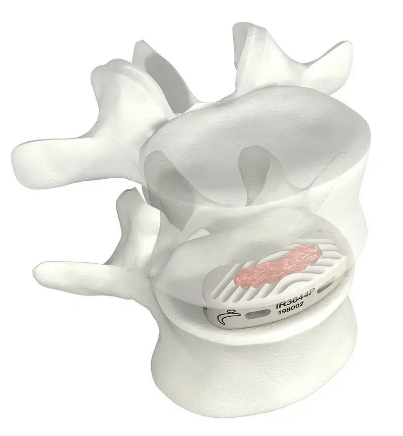 Sm-444 Medical Surgery Implant PEEK TLIF Steel Cage Posterior Lumbar Interbody Fusion System CE Certified 1-Year Warranty Online