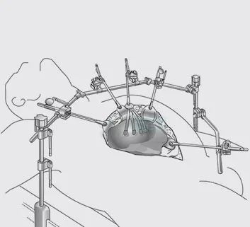 Top Manufacturer Thompson Retractor Set Wholesale Surgical Instruments In Best Rates | Caremed Instruments