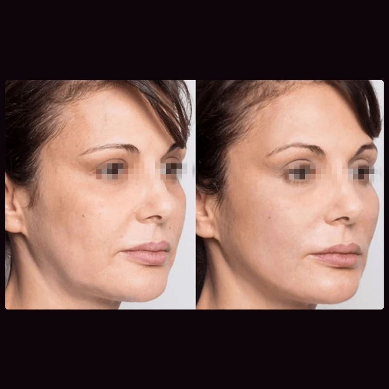 high quality korea nasolabial folds face lift 26g 38mm 60mm models facial lifting tornado pdo thread