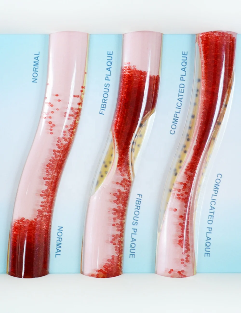 Thrombosis Model Vascular Disease Pathology Demonstration Dynamic Low-Density Lipoprotein LDL Blood Vessel Model