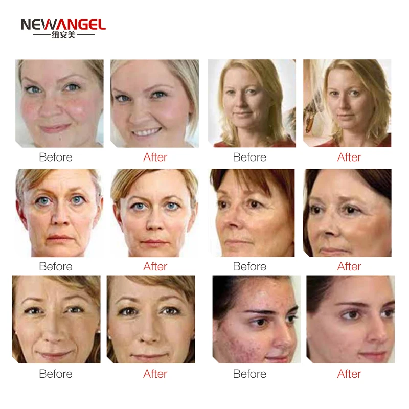 High Quality 9 in 1 Multi-functional H2O2 Hydro Oxygen Facial Bubble Skin Care Oxygen Jet Facial Deep Cleaning