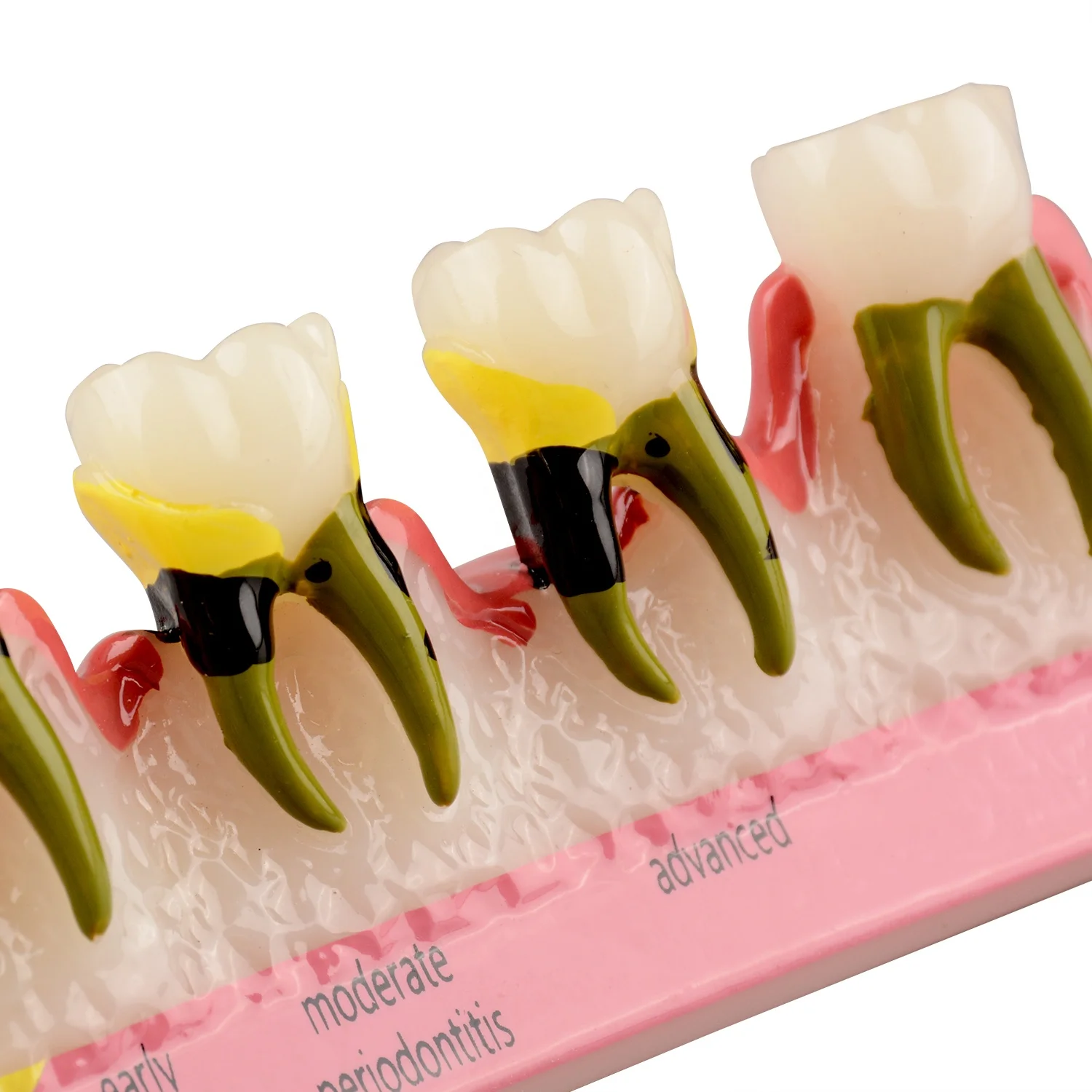 Periodontal Disease Classification Symptoms Stages Model to Show the Grade of Periodontitis