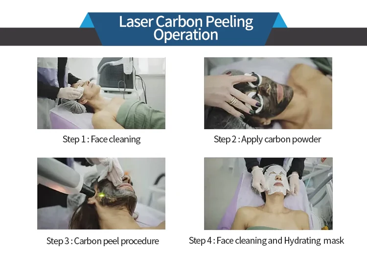 professional tattoo removal device carbon peel laser q switched nd yag laser