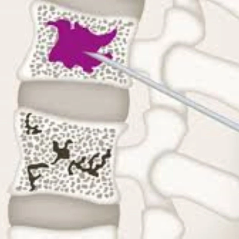 Bone Cement Radiopaque High Viscosity for Ortho 40 gr PMMA  polymethyl methacrylate Sterile Surgical  acrylic  best selling