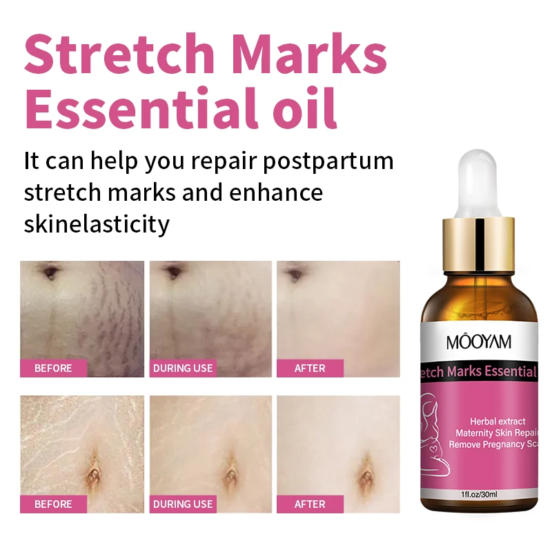 Private label OEM ODM reduce anti pregnancy stretch Pregnant belly stretch marks removal Pregnancy mark oil