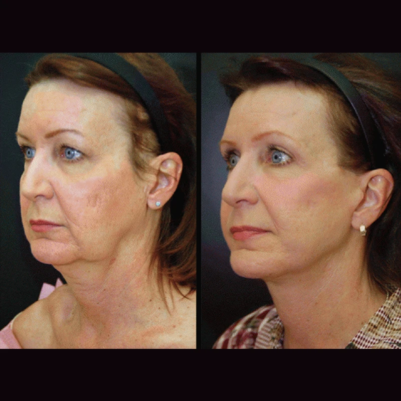 best body lift pdo threads lift 3d korea ultra v lifting 4d  pdo barbed cog thread 4d cog thread