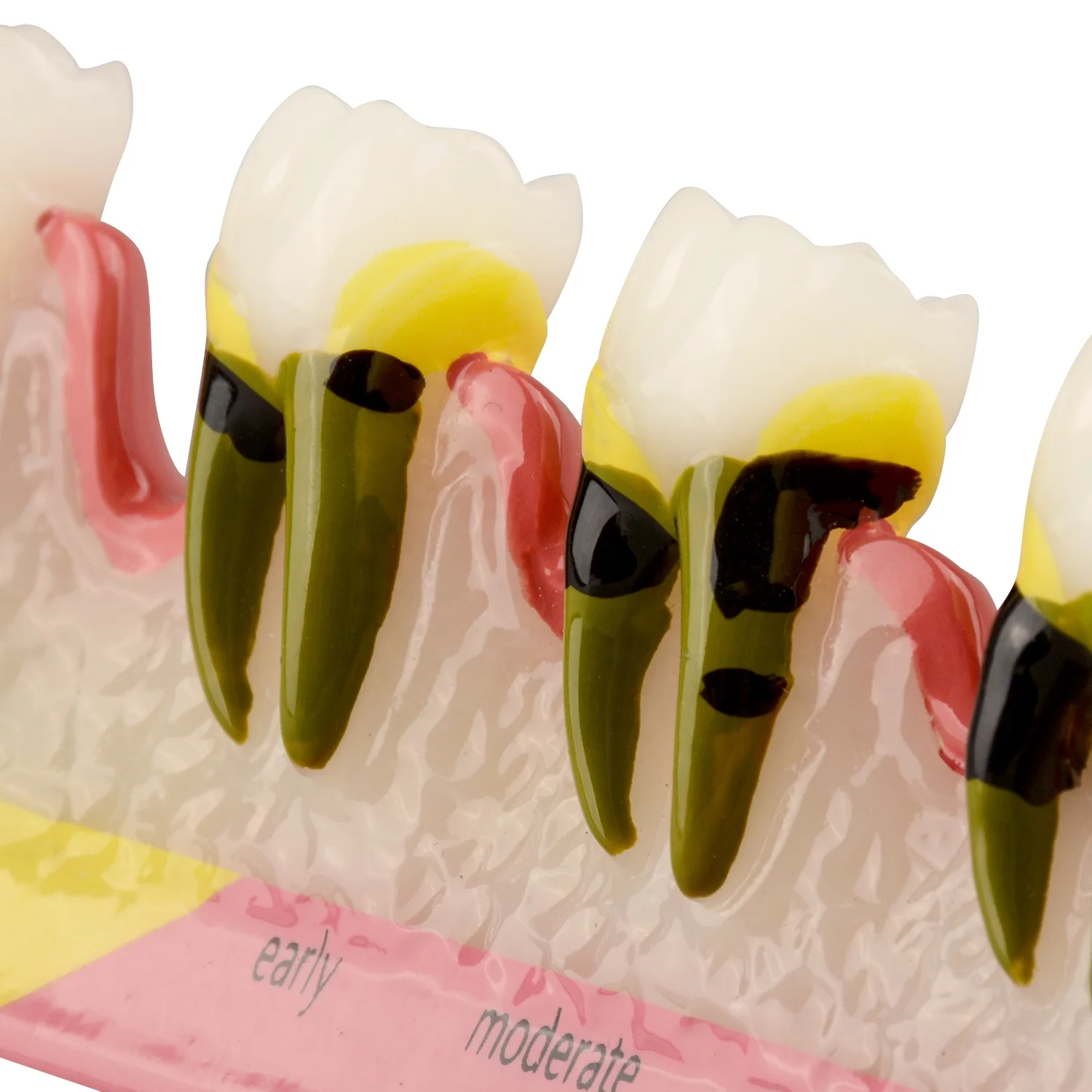 Periodontal Disease Classification Symptoms Stages Model to Show the Grade of Periodontitis
