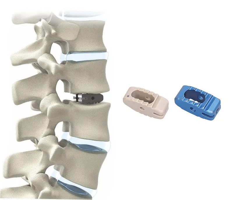 Sm-444 Medical Surgery Implant PEEK TLIF Steel Cage Posterior Lumbar Interbody Fusion System CE Certified 1-Year Warranty Online