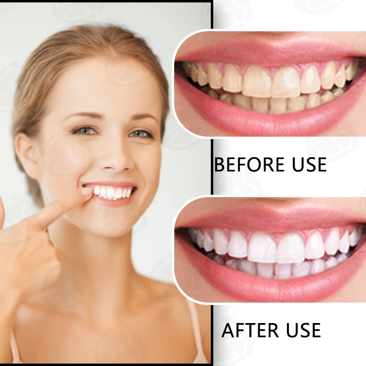 Dental Vendor Lab Medical Syringe Hydroproxide Peroxide Gold Pink Silver 30% 40% 45% 50% Teeth Whitening Gel With Oem