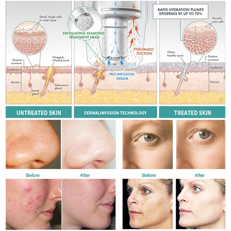 Face massager hydra beauty vaccum handle hydro 8 in 1facial machine home use beauty equipment diamond dermabrasion for salon