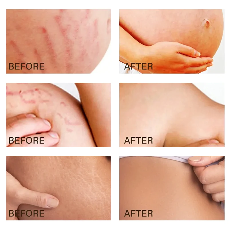 Private label OEM ODM reduce anti pregnancy stretch Pregnant belly stretch marks removal Pregnancy mark oil