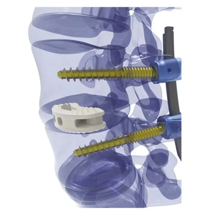 Sm-444 Medical Surgery Implant PEEK TLIF Steel Cage Posterior Lumbar Interbody Fusion System CE Certified 1-Year Warranty Online