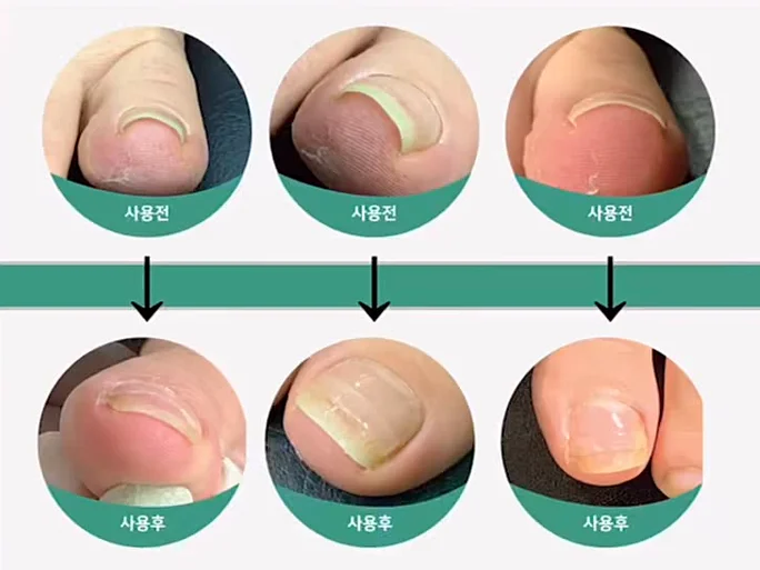 Dr. Kralle hurtless nail kit for ingrown toenail Korean curved toenail corrector simple to use safety and direct effect