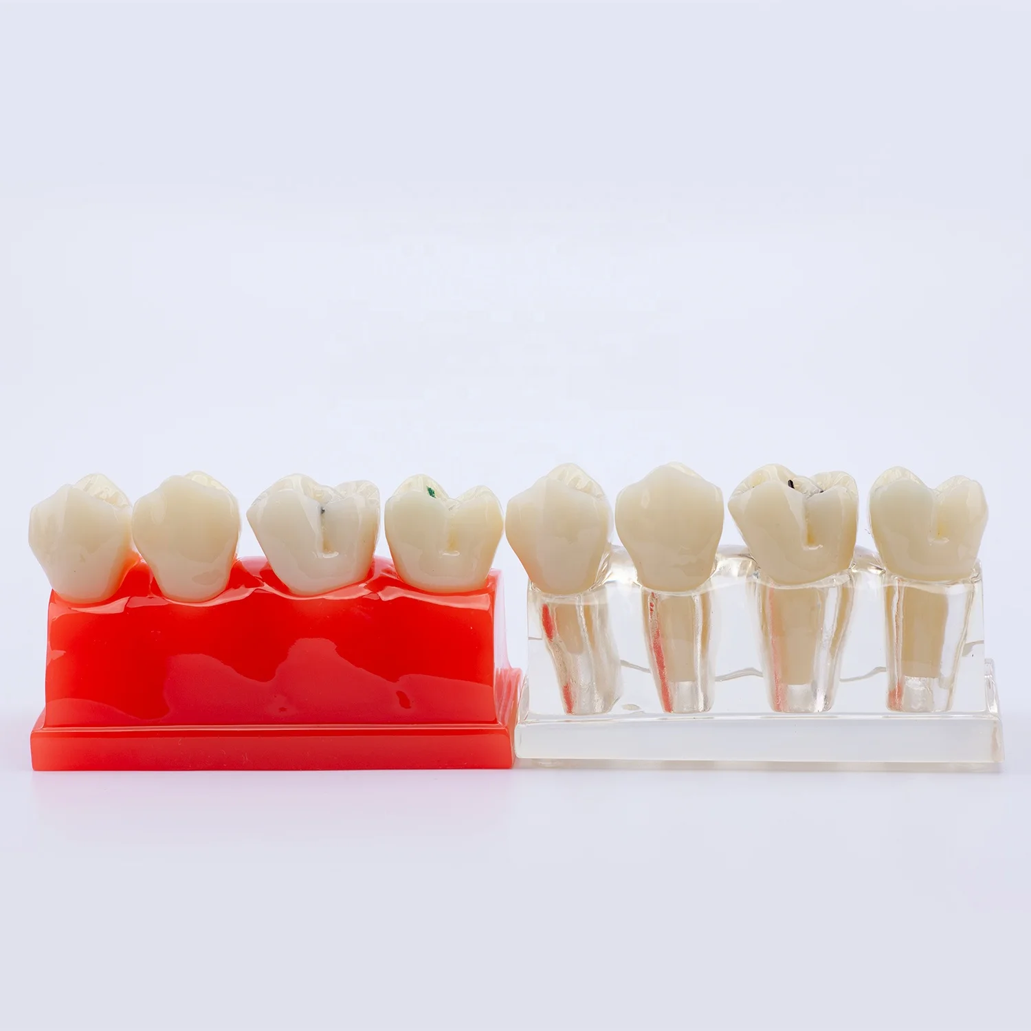 Pit and Fissure Sealant Teeth Model Demonstration Dental Model for for Patients Communication and Education