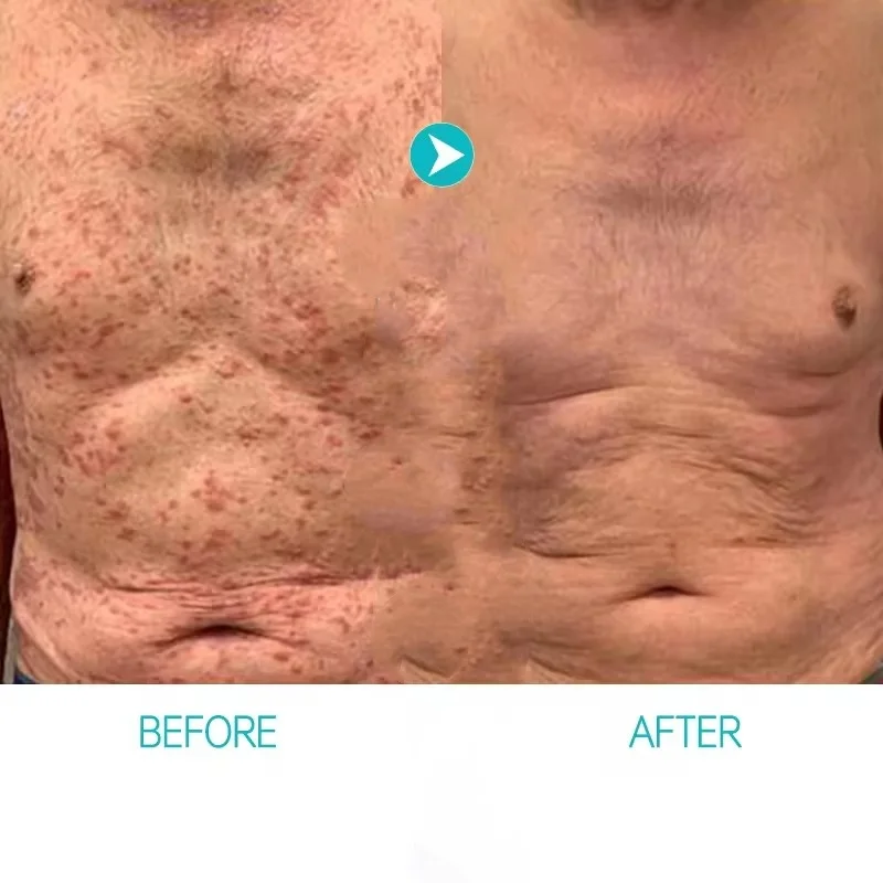 Psoriasis Cream Eczema Natural Herbal  Per Cure Scalp Dry Skin Care Products Against Psoriasis Ointment 50g