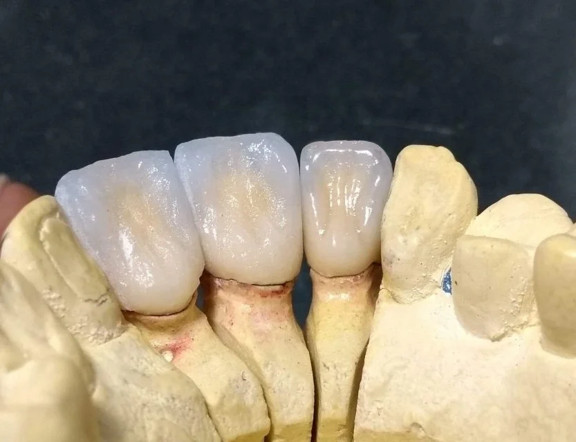 Popular Product Dental Consumable High Quality Alloy NB NP CC SOFT PS TS Used For Dental Lab