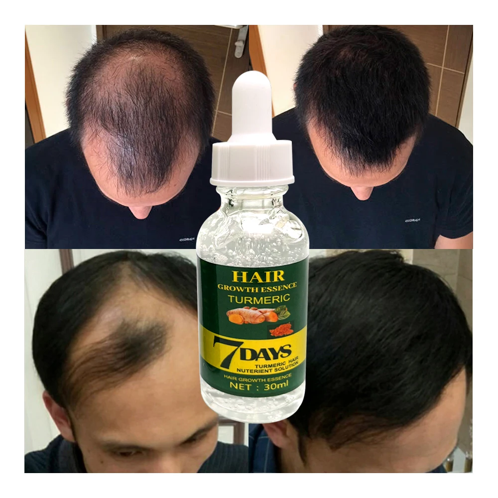 500PCS Customize You Logo 3 Times Faster Hair Loss Treatment Hair Growth Oil