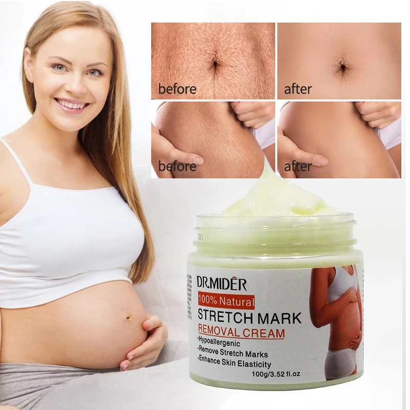New Arrival Stretch Mark Removal Cream Repairing Pregnancy Stretch Mark Remover Anti Scars Cream