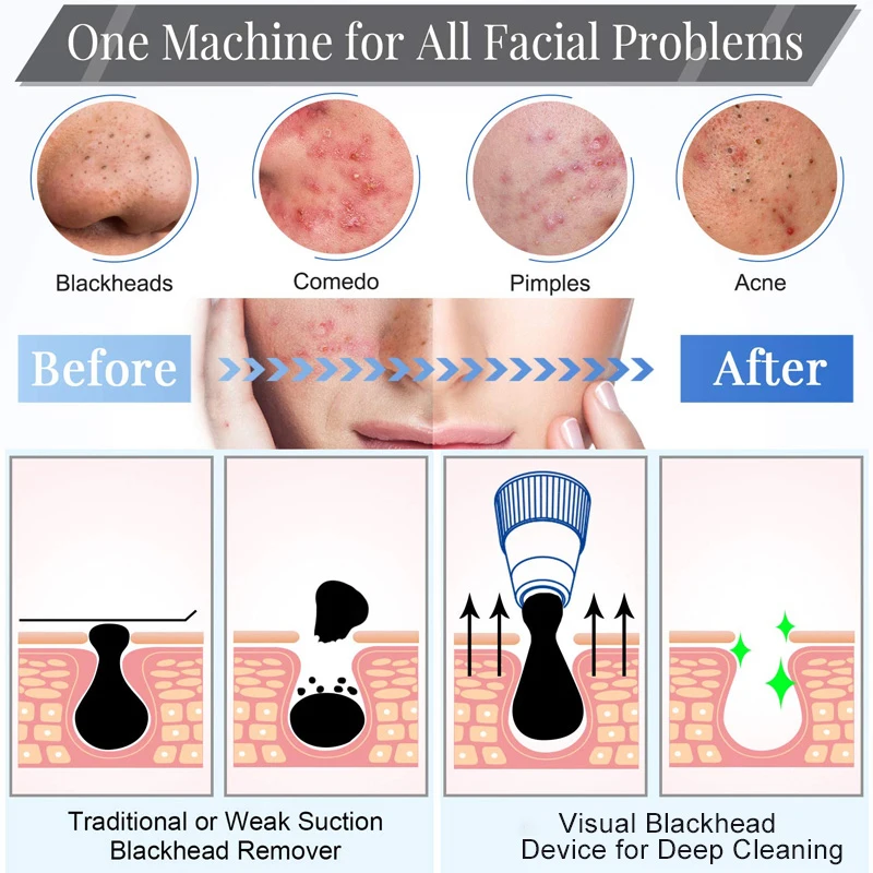 Best Selling USB Rechargeable  Vacuum Blackhead Remover Machine with Camera for Nose Face Acne Pore Cleaner