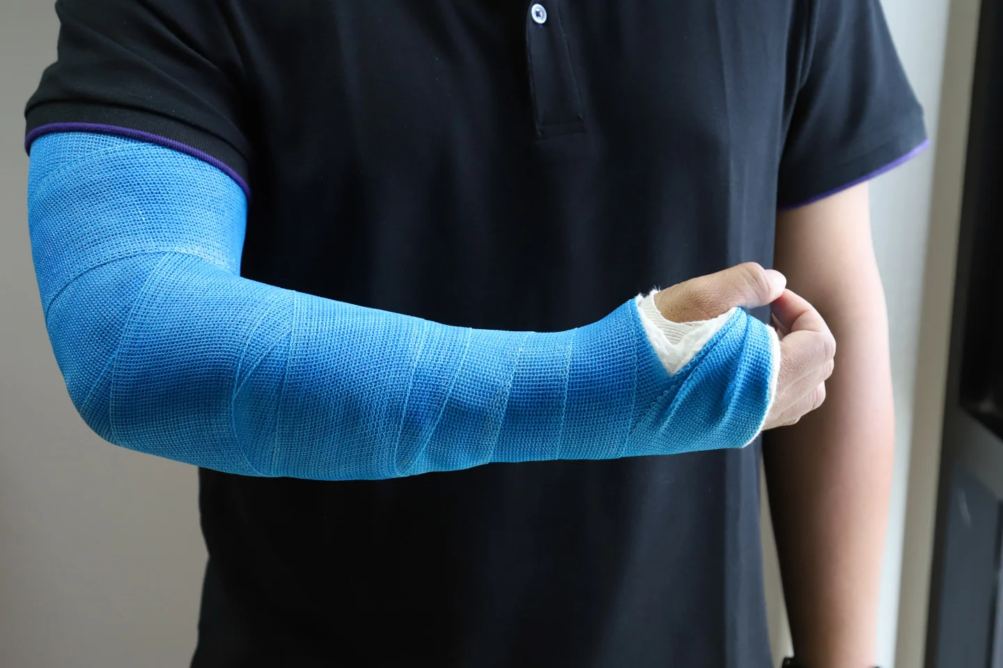 Low Price Medical Device Durable Light weight Blue Surgery Fixation Fiberglass Casting Tape