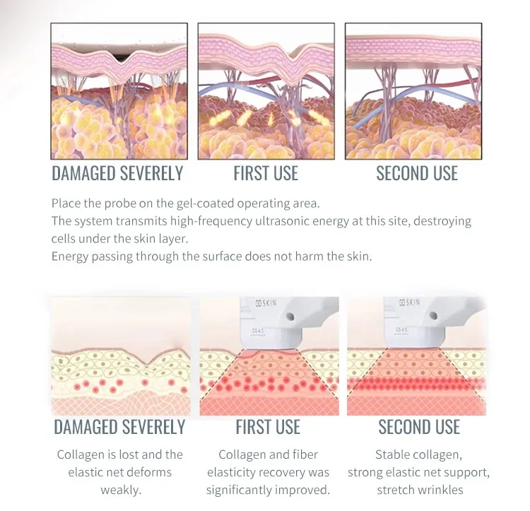 Perfect multifunction device for just opened business, laser hair removal, skin rejuvenation and pigments removal 3 in 1