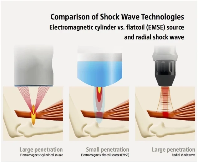 dispositivo de alivio de dolor de eswt terapia de ondas de choque con CE