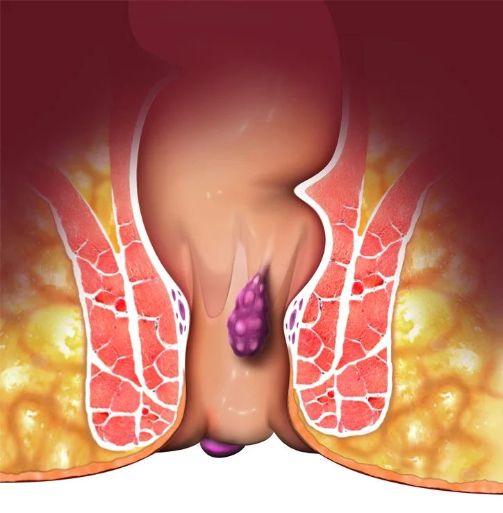Super supplier 980nm 1470nm  diode laser hemorrhoids machine for proctoloy