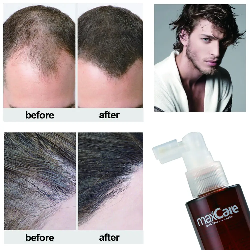 High-quality maxcare ginger hair tonic anti hair loss for hair grwoth