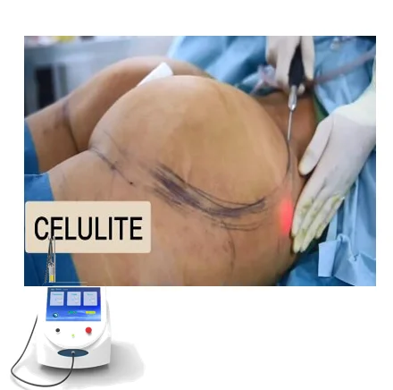 Liposuction Laser 980nm 1470nm Bare Optical Laser Fiber Endoskin Lifting Device Consumables Lipolysis Machine Face Lifting