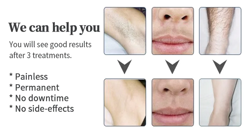 cost effective triple wavelengths 808+755+1064 epliation diode laser hair removal machine beauty machine