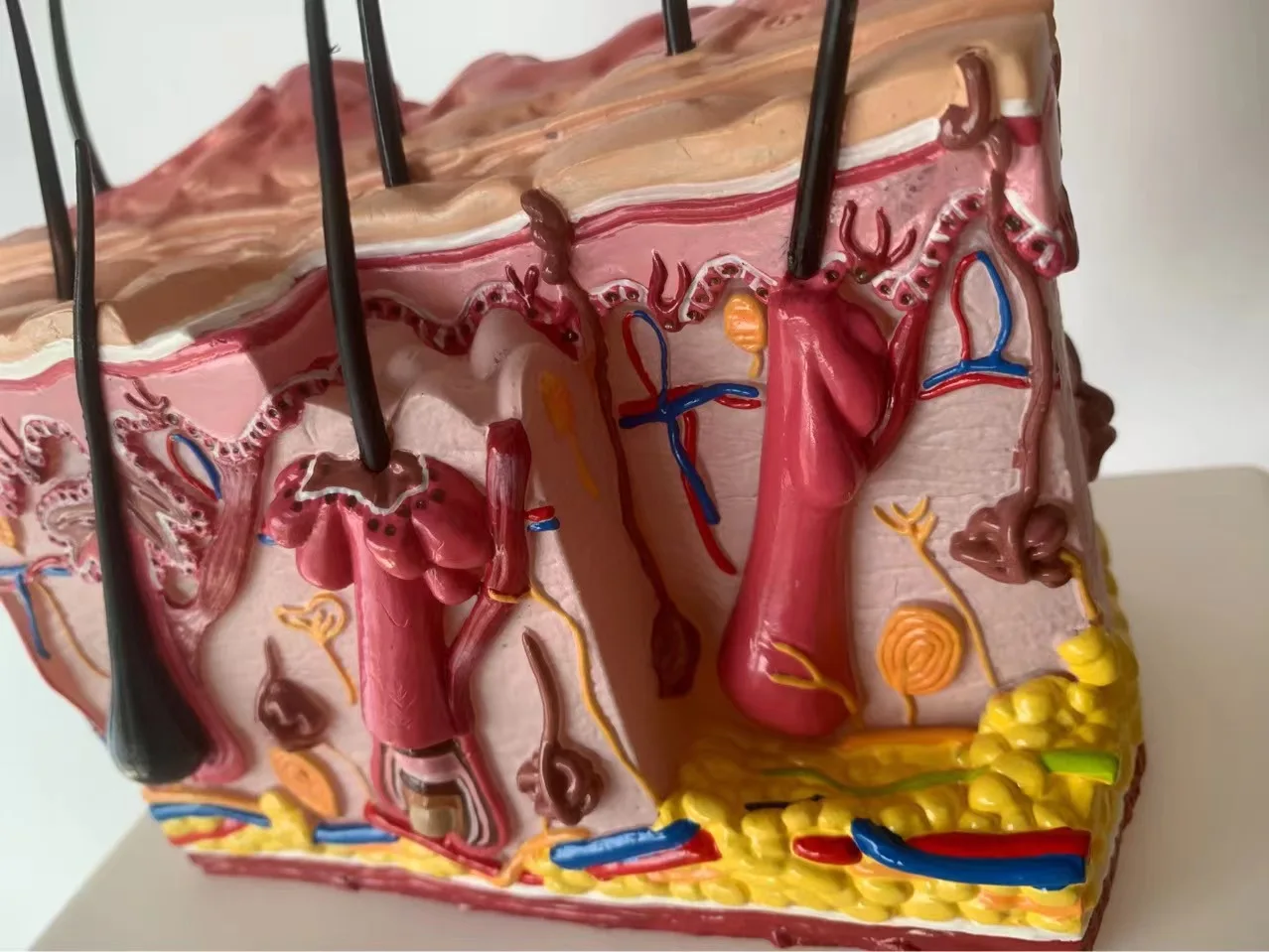 Medical science  biology  pathological skin acne anatomical  structure 3D diseased  model