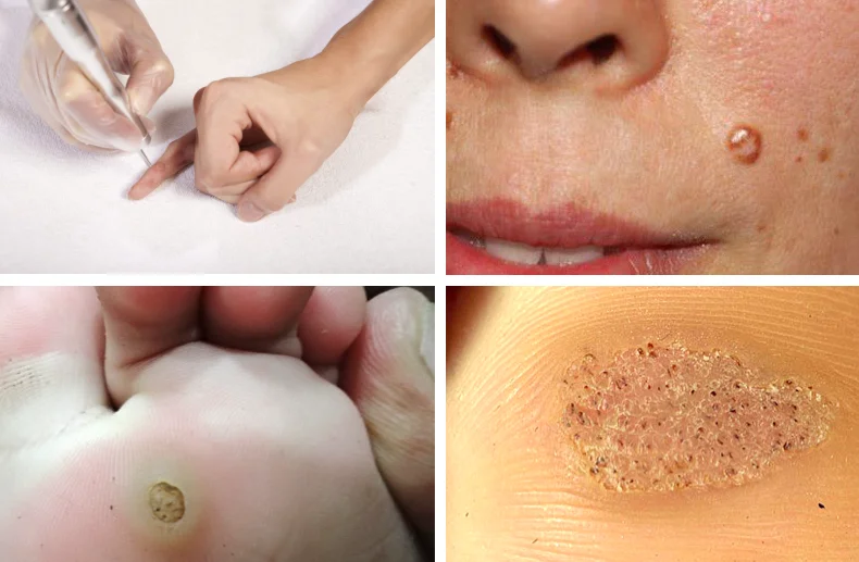 Portable 980nm Laser Wart Removal Machine for Body Wart/Plantar Wart/Corn/Callus