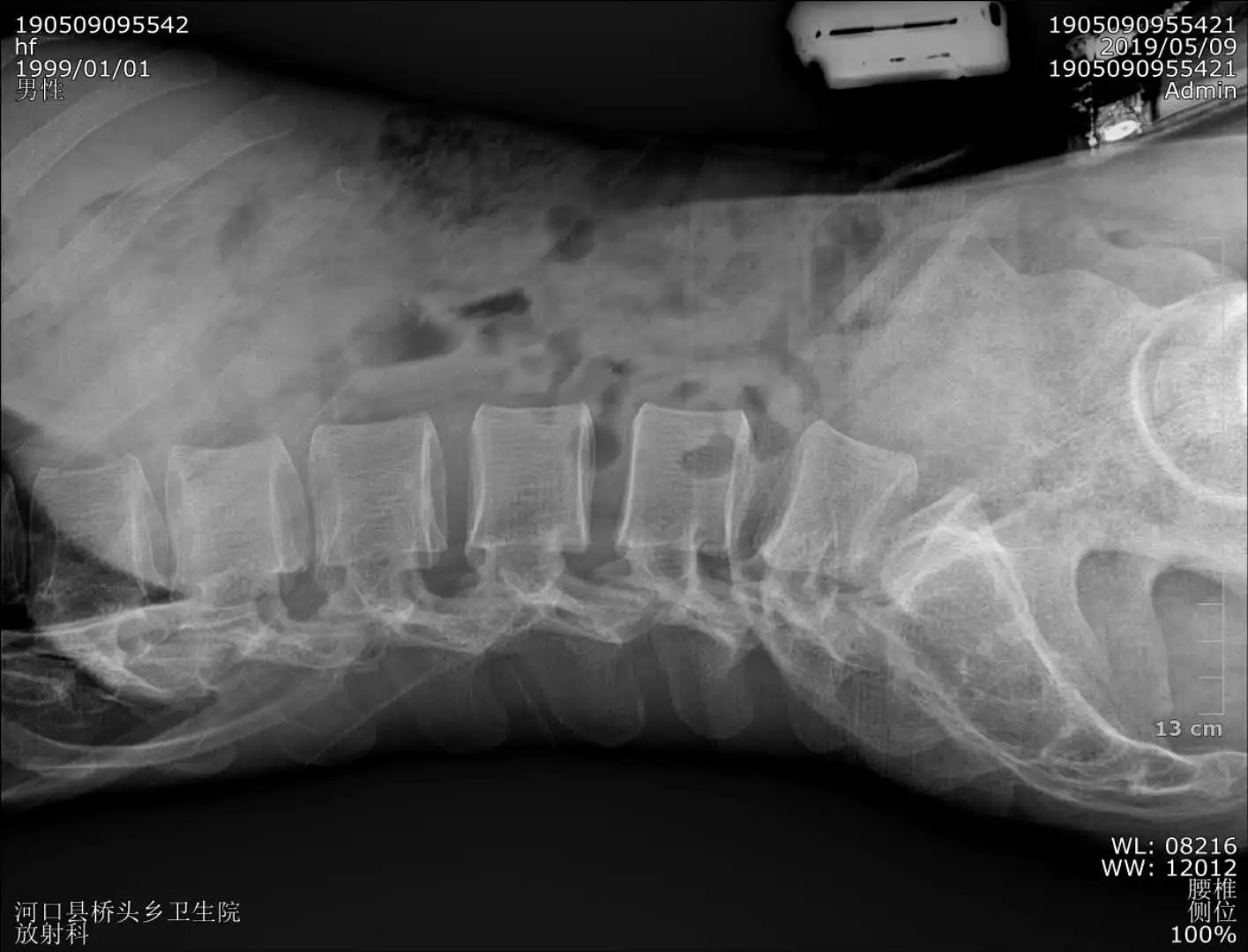 Factory Price CSI Digital 17*17 Wireless X-ray Flat Panel Detector For Human And Veterinary