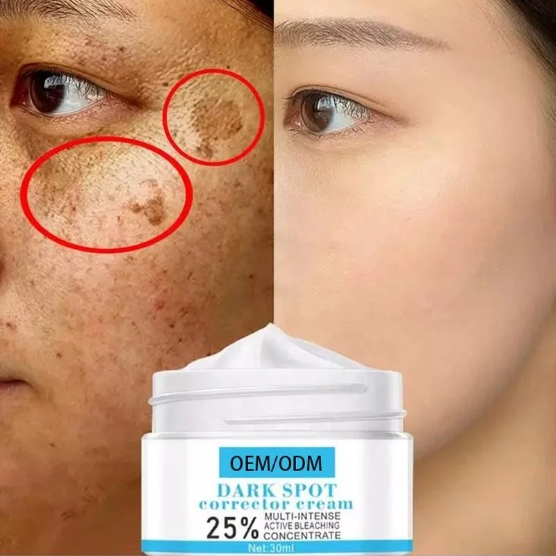 Effective Whitening Freckle Cream Remove Melasma Acne Spot Pigment Melanin Dark Spots Pigmentation whitening freckle cream