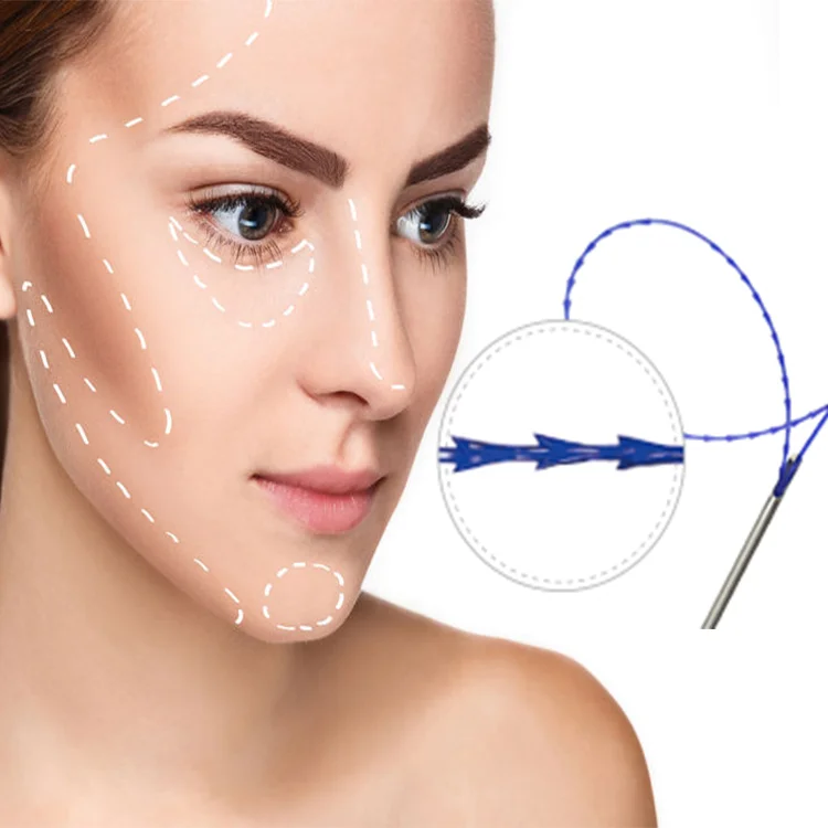 Pdo thread double mono screw  30G25mm lift quality pdo thread face dermal filler facial dermal fillers