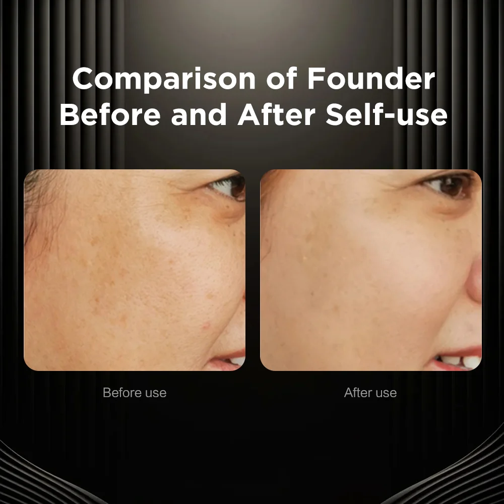 Easy Using Anti-aging Wrinkle Removal Skin Beauty Home Use RF beauty Device/Machine