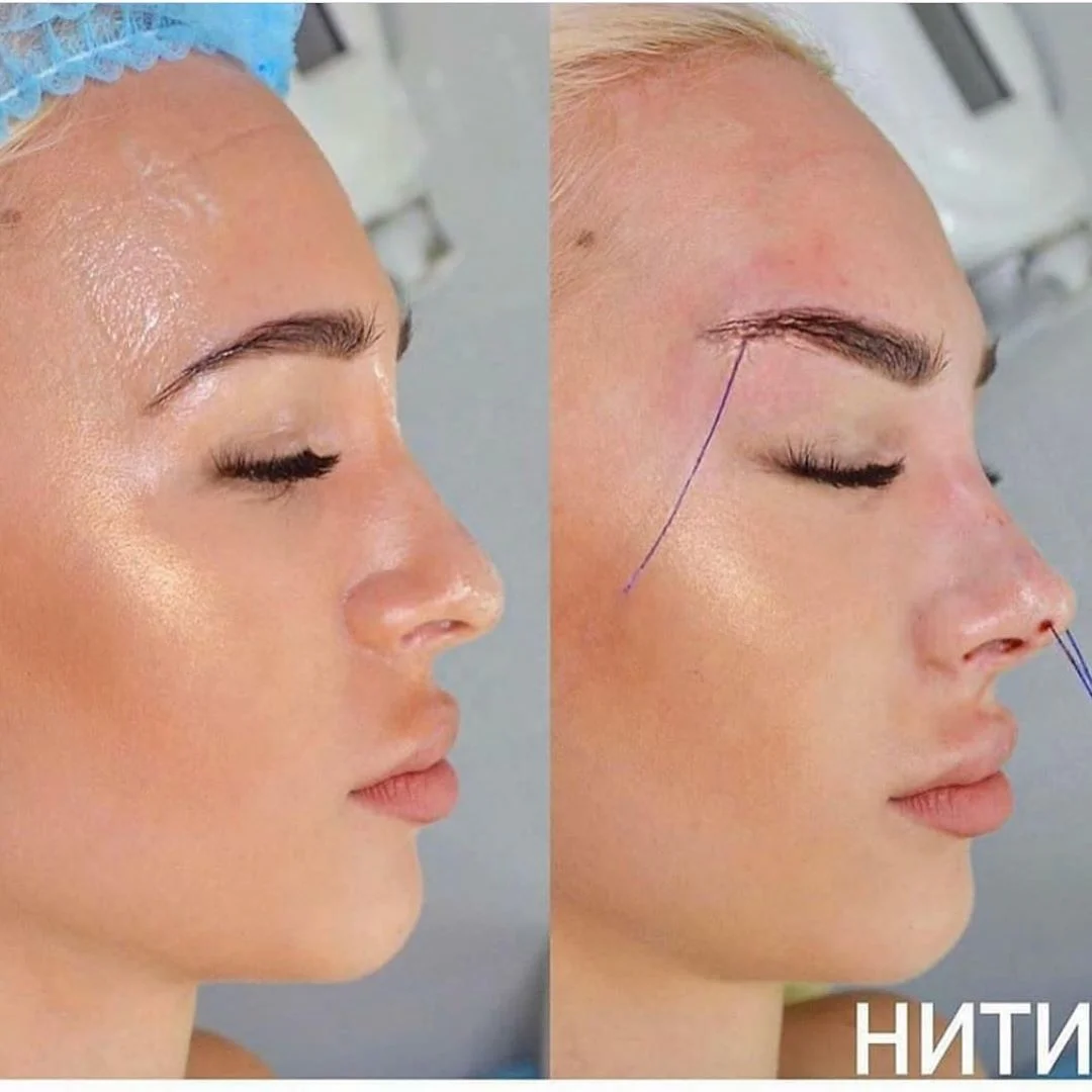Резьба 4d Cog Pdo Fox Eyes Facelift использует впитываемую моно-винтовую резьбу Pcl