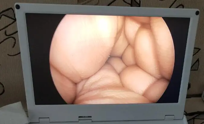 ENT sinuscope 2.7mm 4mm