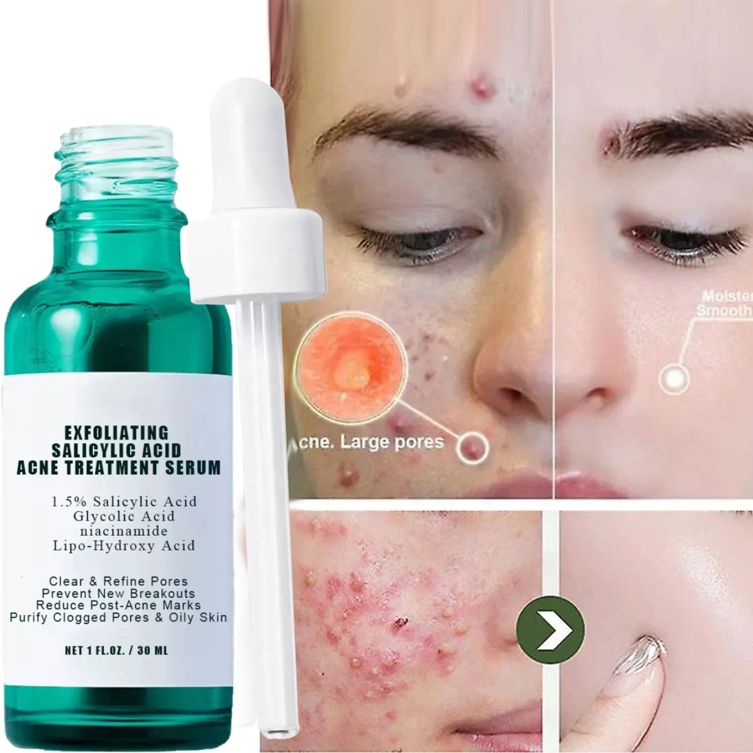 Salicylic Acid Acid Acne Serum Shrink Pores Exfoliating Remove Acne Blackheads Skin Care Face Serum