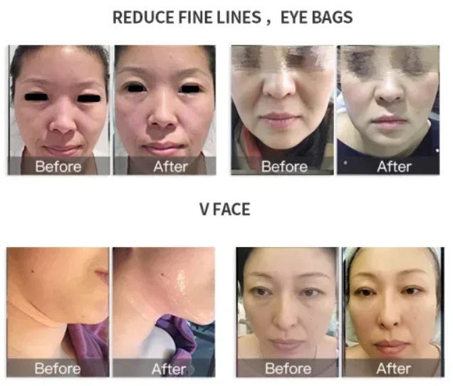 2023 Newest RF Skin Tightening Face Lifting Neck Care Wrinkle Removal Indiba Beauty Machine