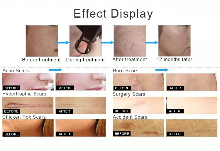 Clinic use Vagina Tightening and Acne Scar removal CO2 Fractional Laser machine