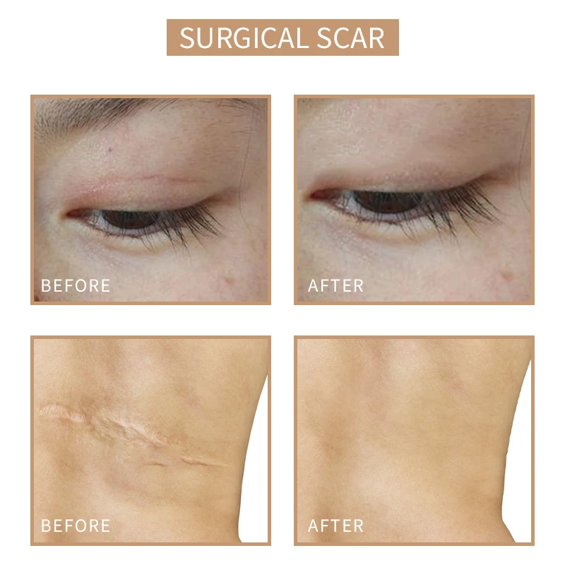 Private Label Stretch Mark Camouflage Vitiligo Pigment Semi Permanent Skin Micropigmentation kit